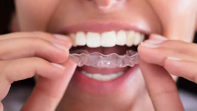 Шість причин вибрати елайнери Invisalign